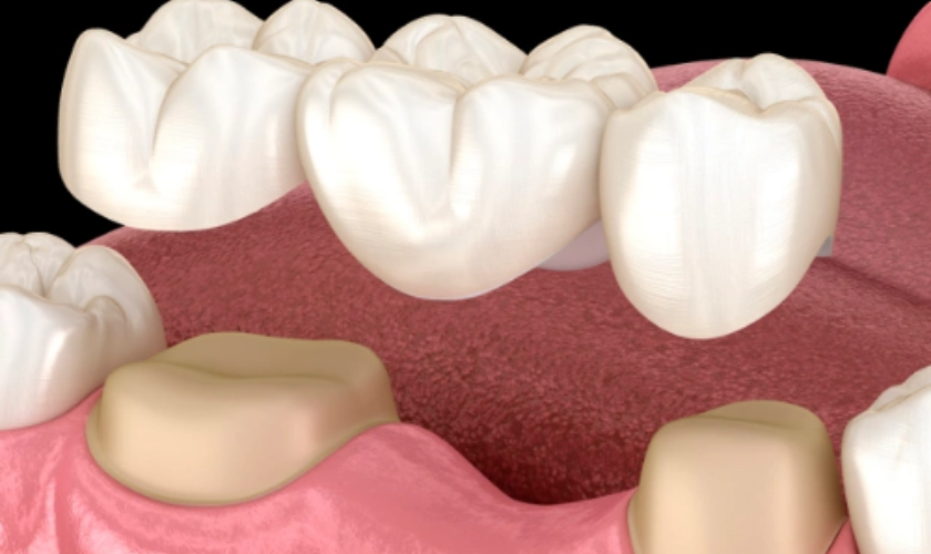 close up of Dental bridges performed at Palouse View Dental, Moscow