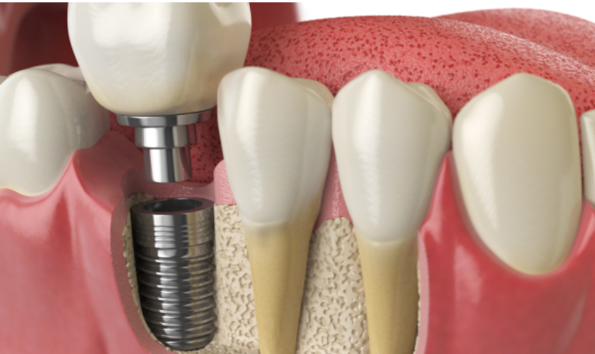 A close-up of dental implant shown to the patient by dentist at Palouse View Dental, Moscow